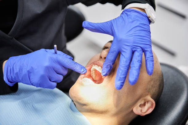 Best Emergency Wisdom Teeth Removal in San Ramon, CA